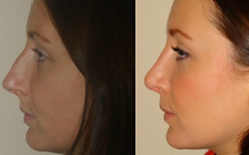 تعریفِ لیفت بینی با نخ