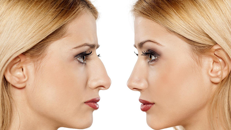 فرآیند لیفت بینی با نخ