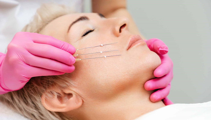 هزینه لیفت نخ در تهران