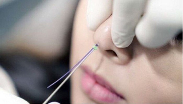 مراقبت های بعد از لیفت بینی با نخ