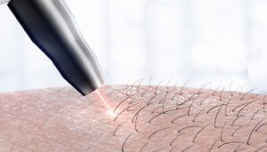 اندازه مو برای لیزر موهای زائد