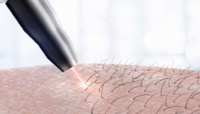 اندازه مو برای لیزر موهای زائد