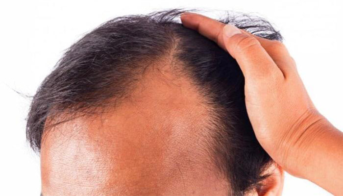 راه های پیشگیری ریزش مو