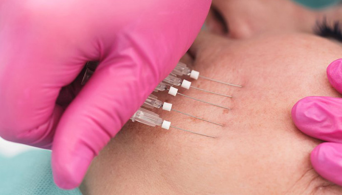 علائم پاره شدن نخ لیفت صورت