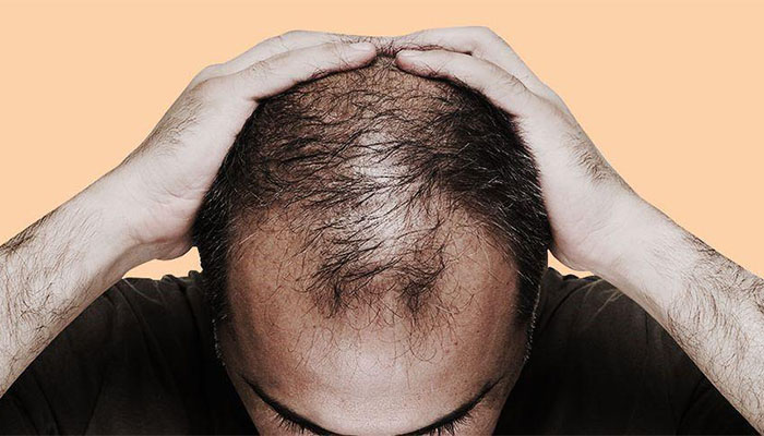 علت ریزش مو
