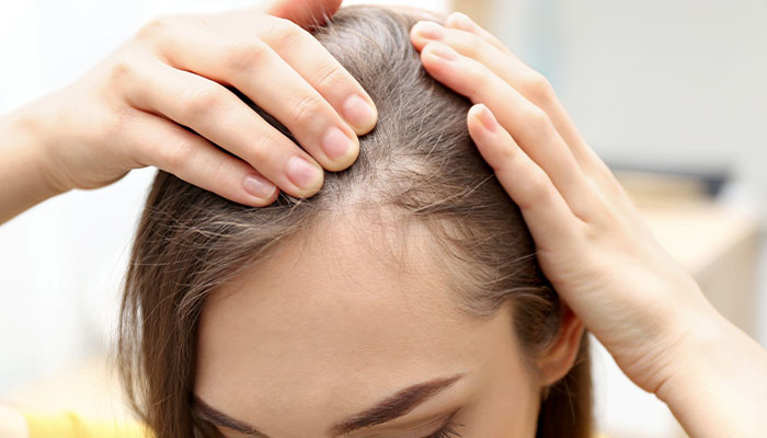 علت ریزش مو