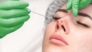 مراقبت های بعد از لیفت بینی با نخ