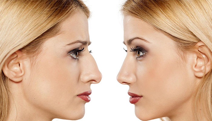 مراقبت های بعد از لیفت بینی با نخ