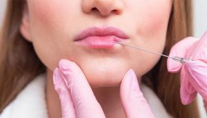 تزریق ژل لب مدل غنچه ای