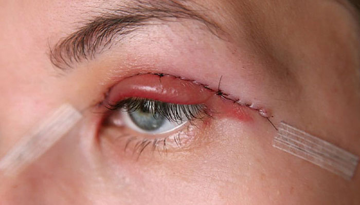 مراقبت های بعد از لیفت پلک