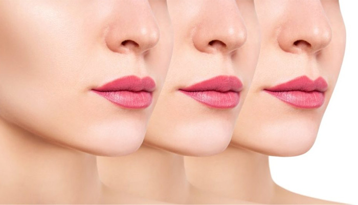 تزریق ژل لب مدل غنچه ای