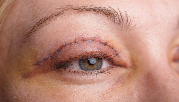 مراقبت های بعد از لیفت پلک