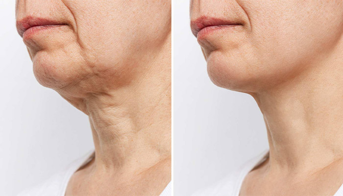 بهترین شیوه جوان ‌سازی پوست گردن