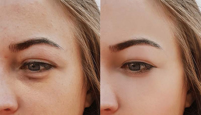 کاربرد های فیلر چشم چیست؟