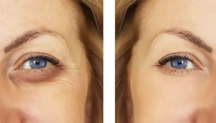 کاربرد های فیلر چشم چیست؟