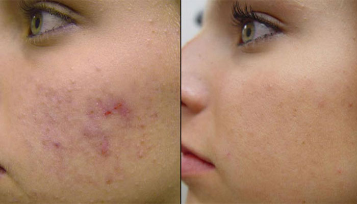 فواید میکرونیدلینگ صورت