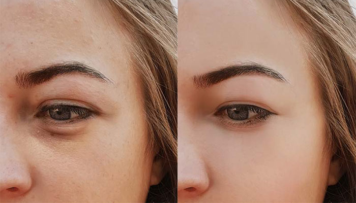 تاثیر فیلر زیر چشم