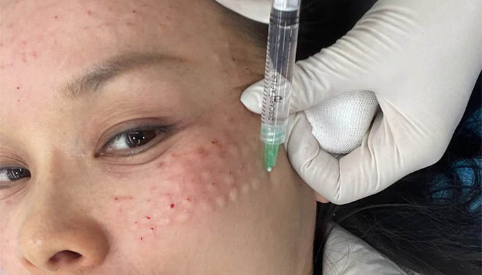 عوارض مزوژل صورت