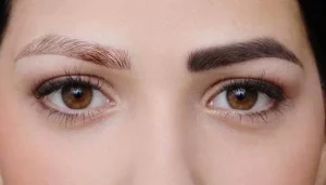 نحوه پاک کردن تاتو با لیزر