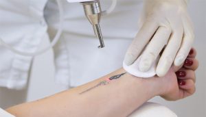 آموزش پاک کردن تاتو بدن