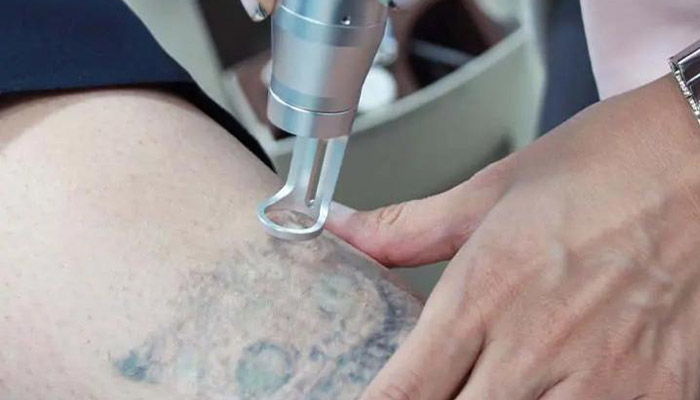 آموزش پاک کردن تاتو بدن