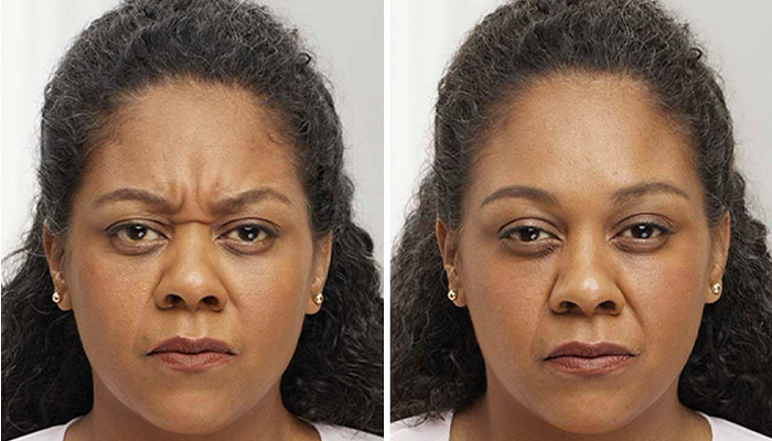 رفع چین و چروک های پیشانی