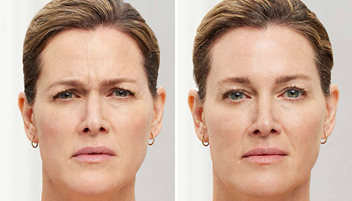 رفع چین و چروک های پیشانی