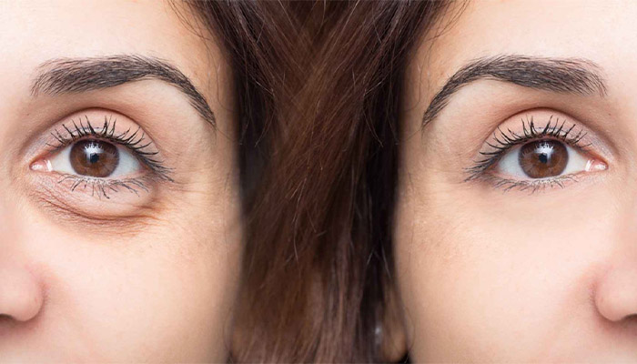 روش های درمان پف زیر چشم