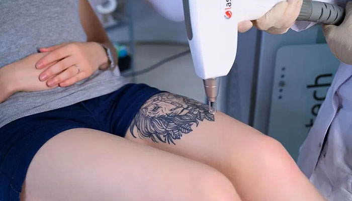 نحوه پاک کردن تاتو با لیزر