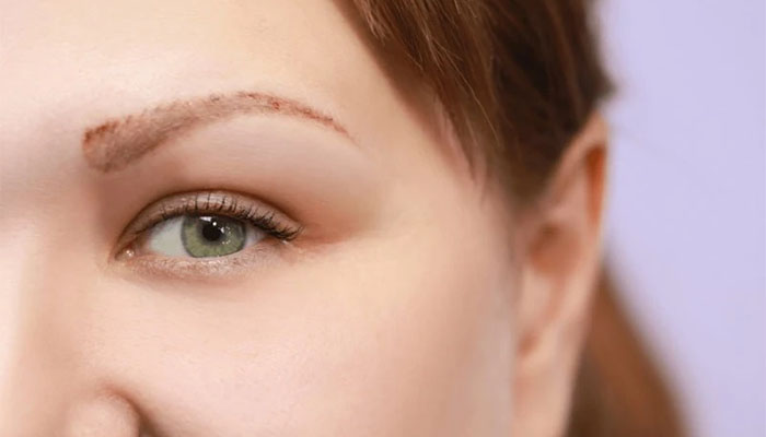 نحوه پاک کردن تاتو با لیزر