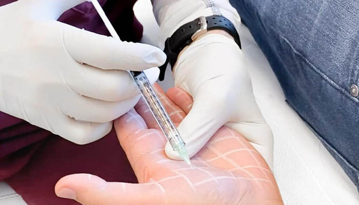 هزینه بوتاکس کف دست و پا