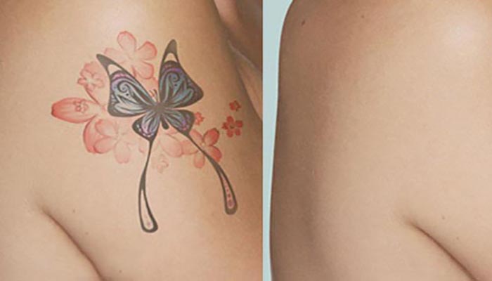 پاک كردن تاتو در يك جلسه