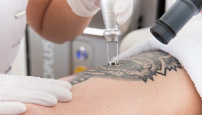 آموزش لیزر تاتو با نازل ترین قیمت