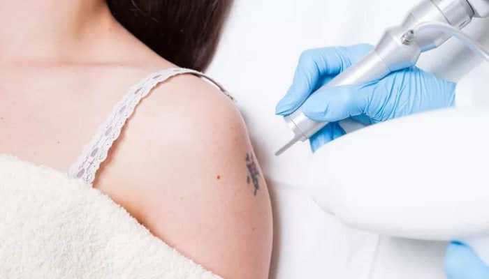 آموزش لیزر تاتو با نازل ترین قیمت