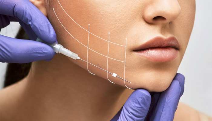 آموزش لیفت با نخ