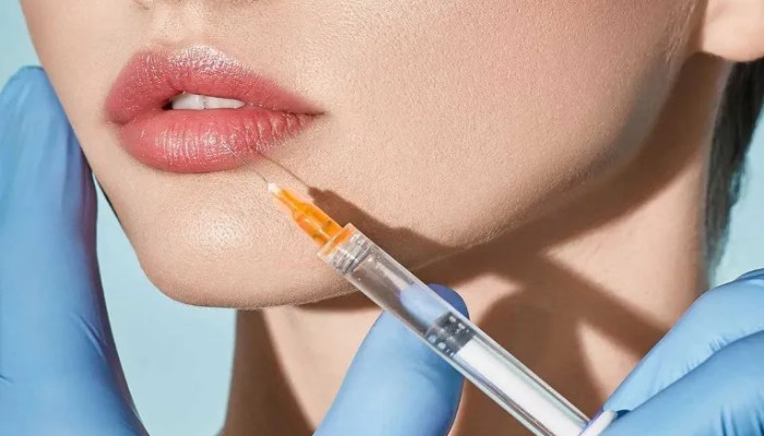 تزریق ژل لب مدل صدفی