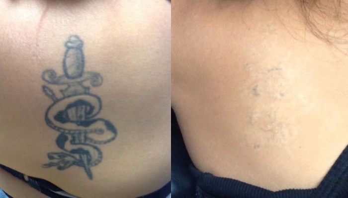 هزینه پاک کردن تاتو با لیزر