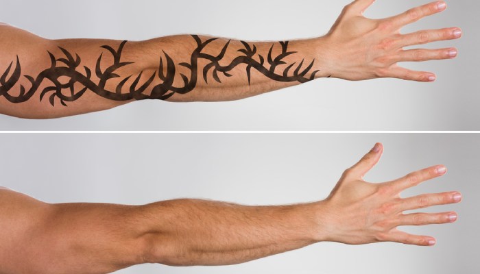 هزینه پاک کردن تاتو با لیزر