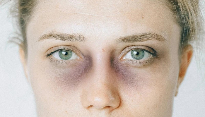 اشتباهات رایج بعد از تزریق فیلر