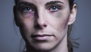 روش های کاهش کبودی بعد بوتاکس