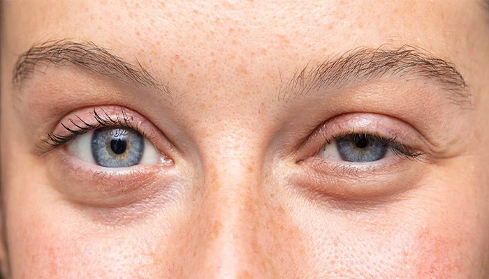 علت افتادگی پلک بعد از بوتاکس