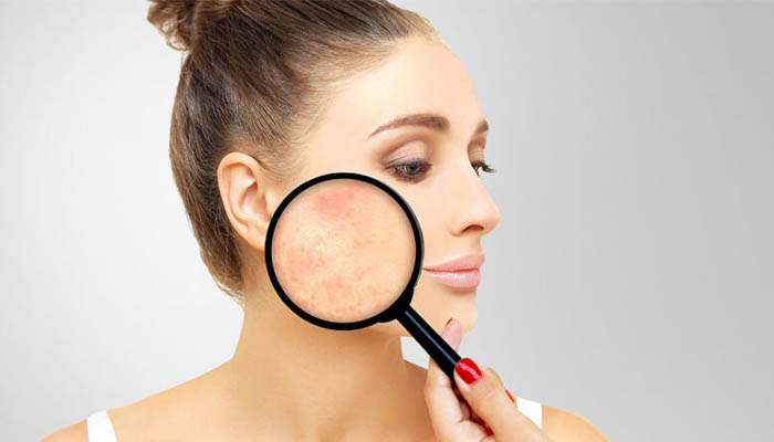 نحوه درمان لک صورت