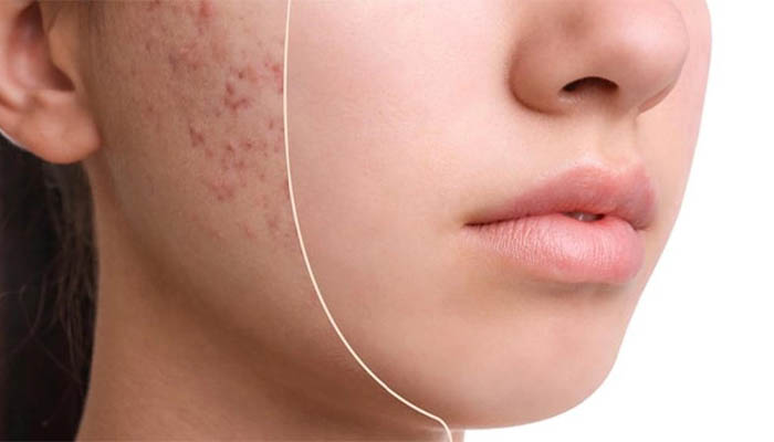 نحوه درمان لک صورت