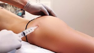 تزریق فیلر باسن