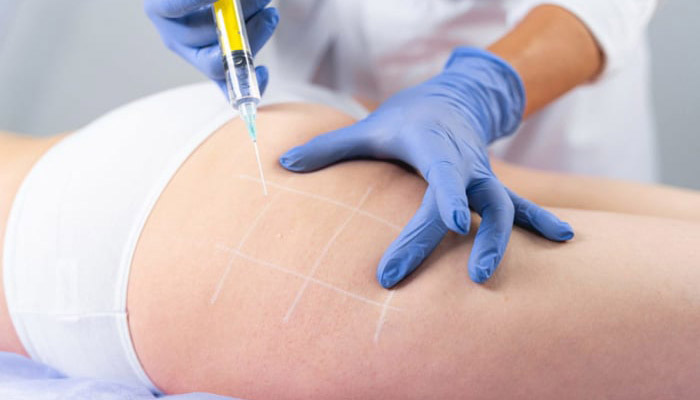 تزریق فیلر باسن