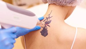 مزایا و معایب پاک کردن تاتو بدن