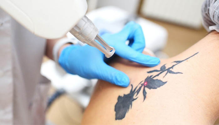 مزایا و معایب پاک کردن تاتو بدن