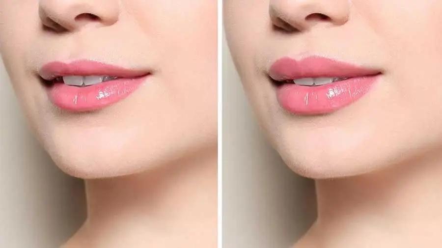 تفاوت فیلر لب با ژل لب