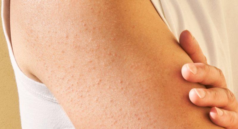 روش های درمان پوست مرغی