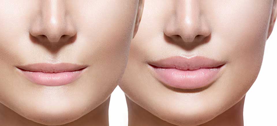 بررسی کامل و جامع تفاوت فیلر لب با ژل لب